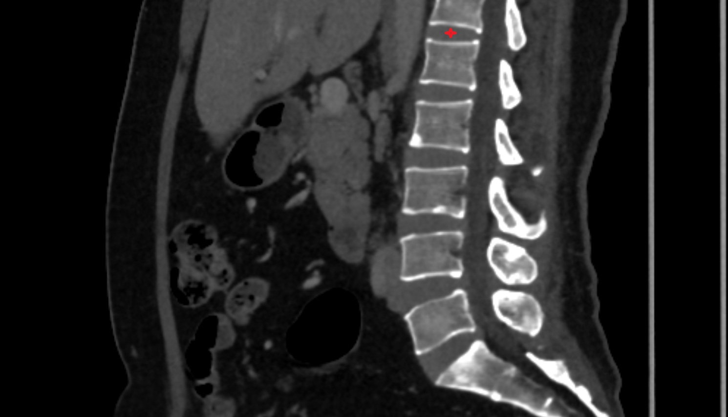 T12 –L1  Intervertebral Disc  CT sagittal  anatomy  image-img-00000-00000