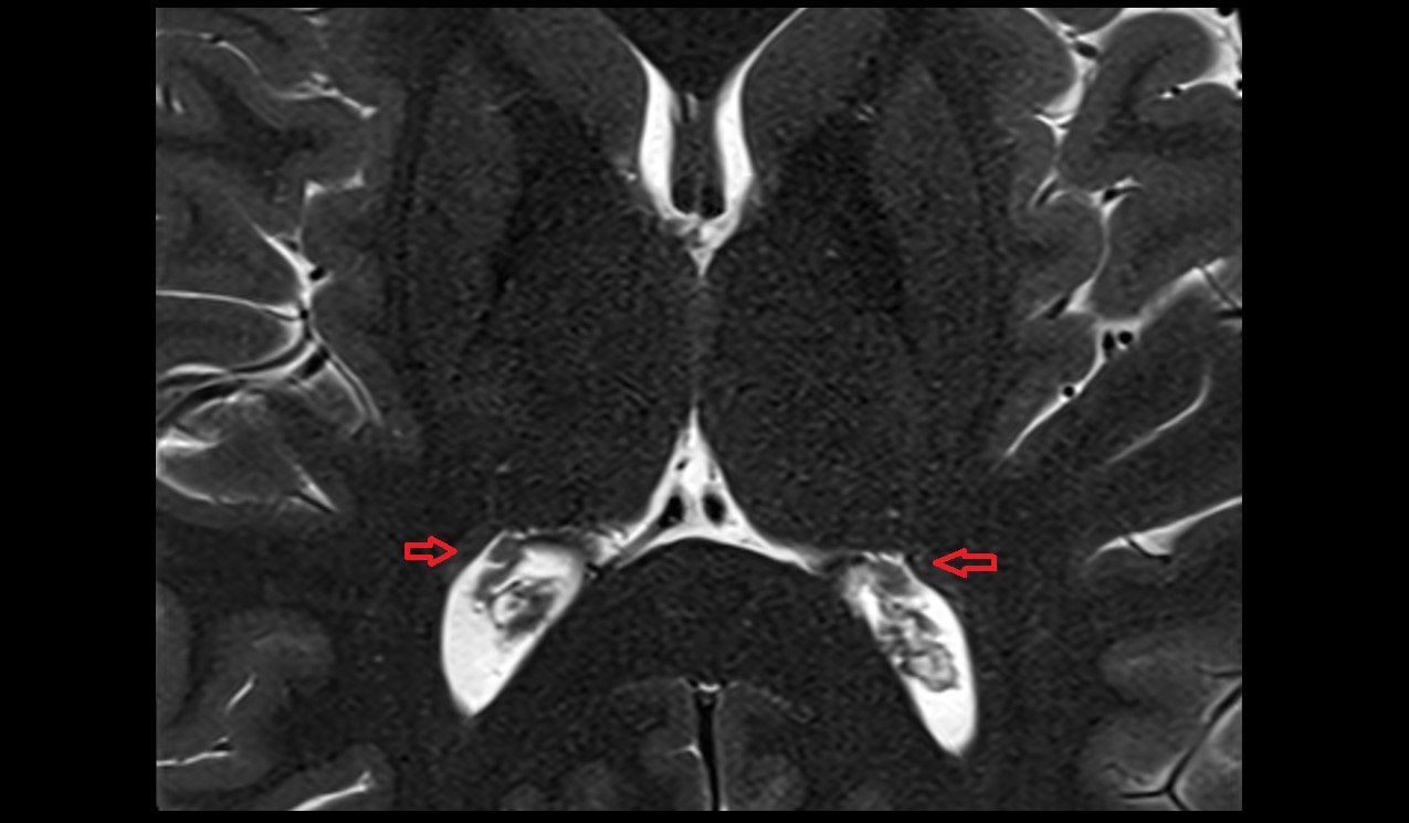 Tail of caudate nucleus mri 3t axial image