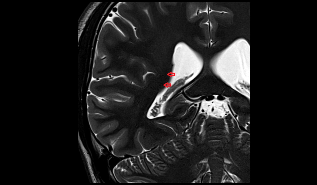 Tail of caudate nucleus mri 3t coronal image