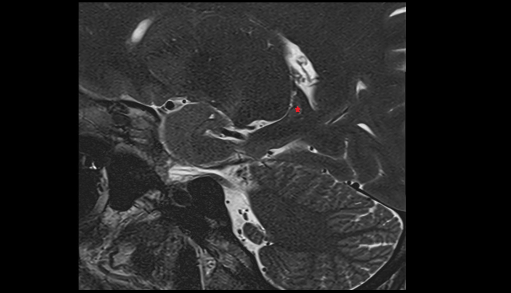 Tail of hippocampus MRI SAG IMAGE