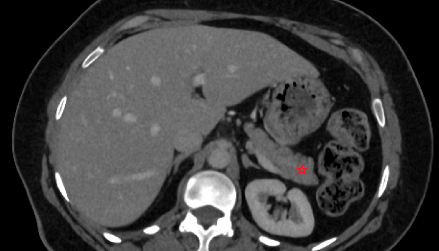 Tail of pancreas  CT  axial  anatomy image-img-00000-00000