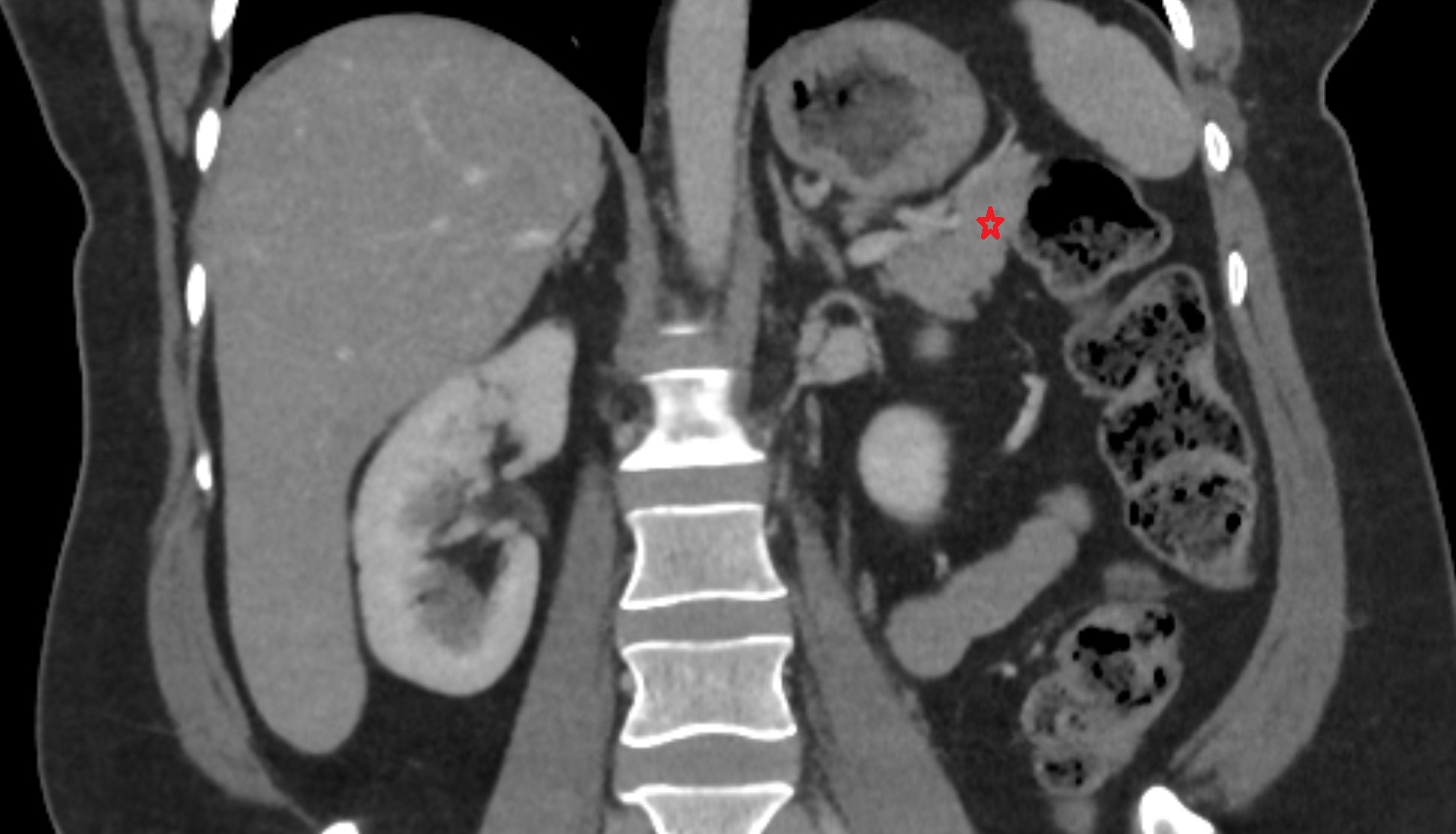 Tail of pancreas  CT  coronal  anatomy image-img-00000-00000