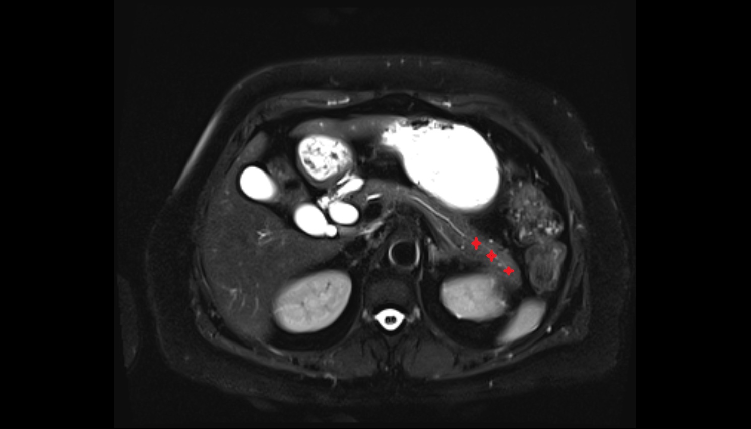 Tail of pancreas  MRI axial  anatomy image-img-00000-00000