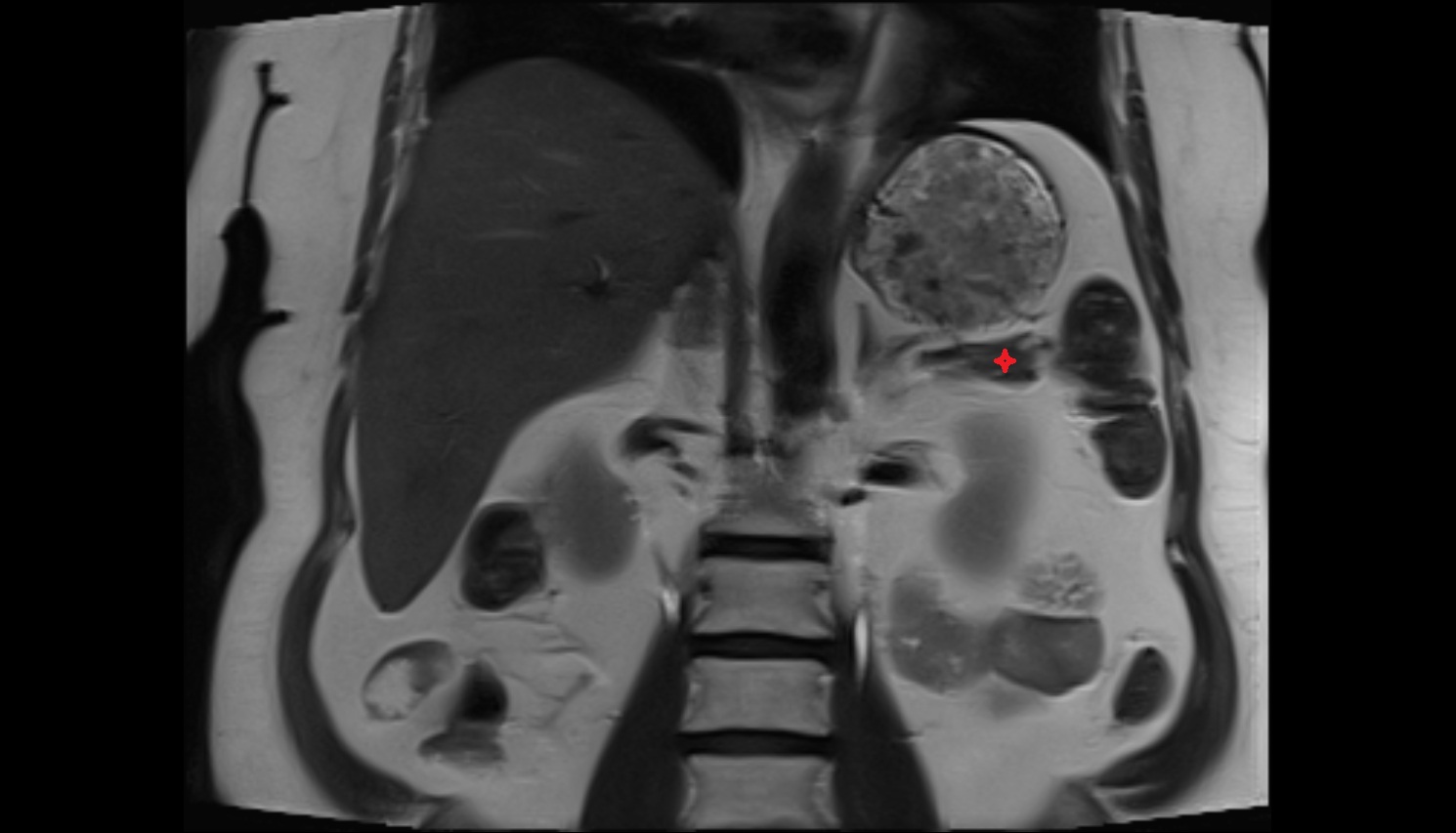 Tail of pancreas MRI coronal  anatomy image-img-00000-00000