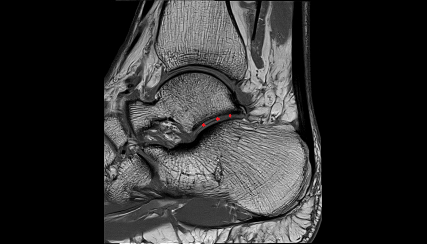 Talocalcaneal Joint (Subtalar Joint)  MRI sagittal  cross sectional anatomy 3T MRI AI enhanced radiology image-img-00000-00000