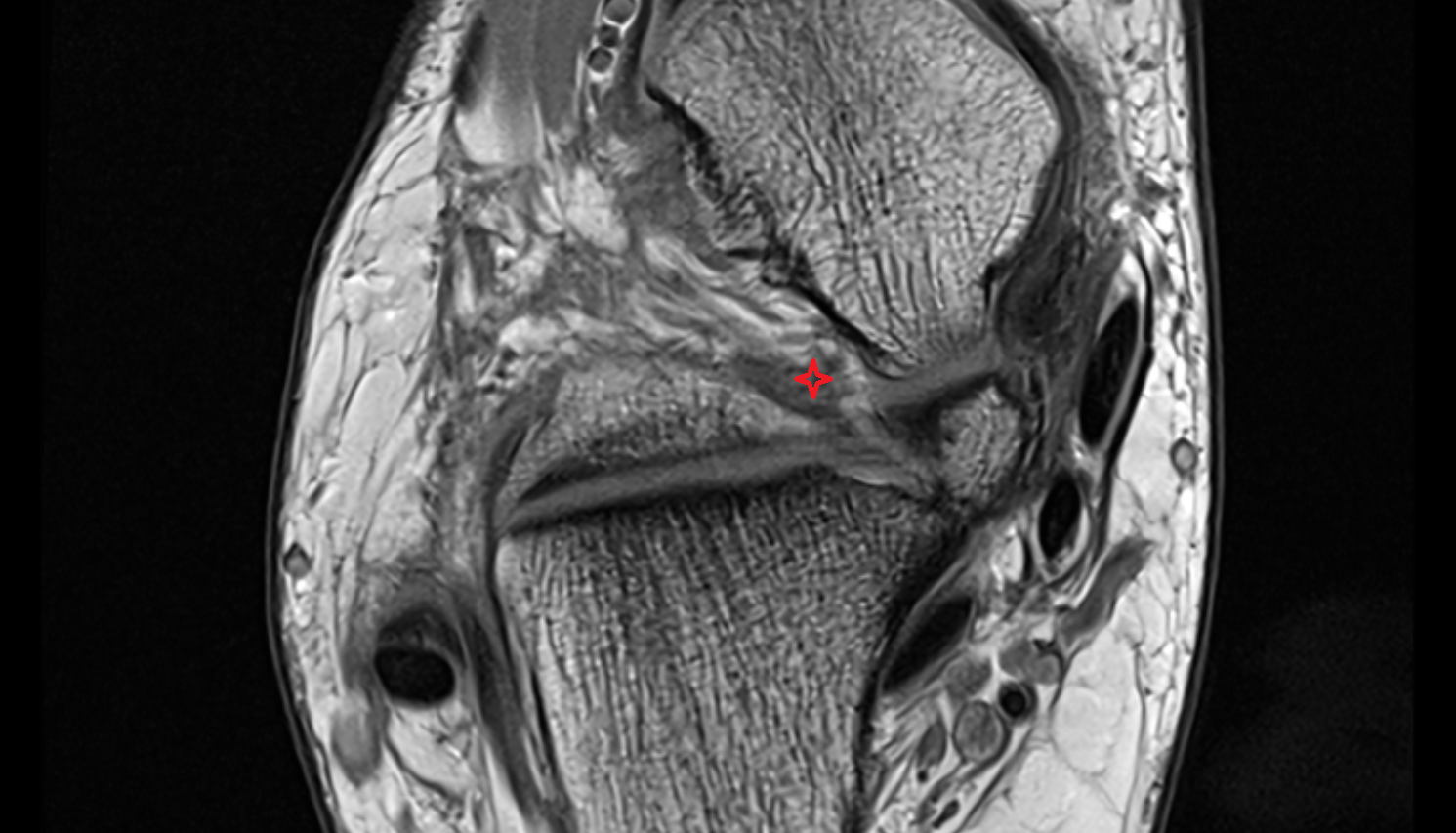 Talocalcaneal interosseous ligament  axial cross sectional anatomy 3T MRI AI enhanced radiology image-img-00000-00000