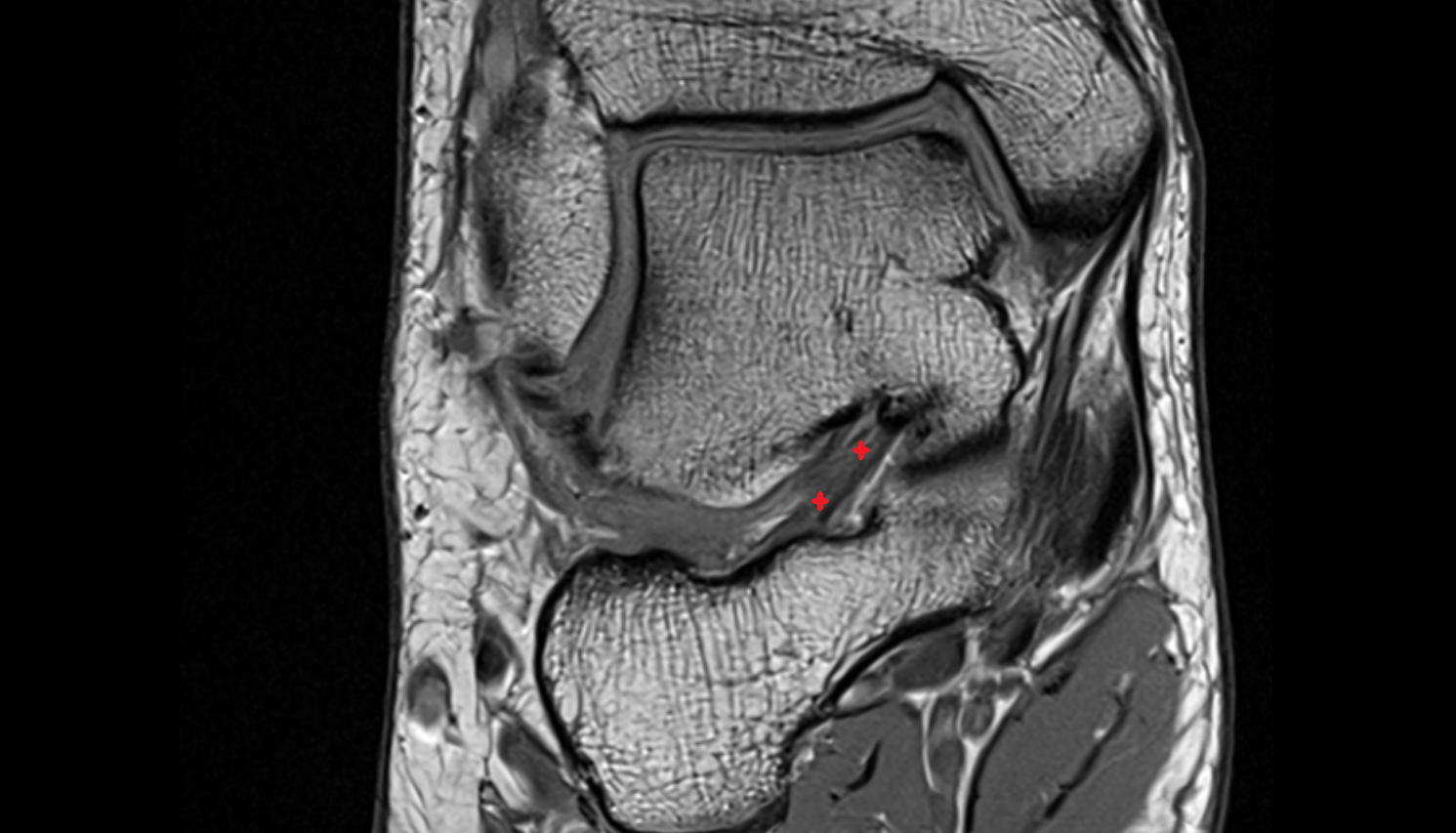 Talocalcaneal interosseous ligament coronal cross sectional anatomy 3T MRI AI enhanced radiology image-img-00000-00000