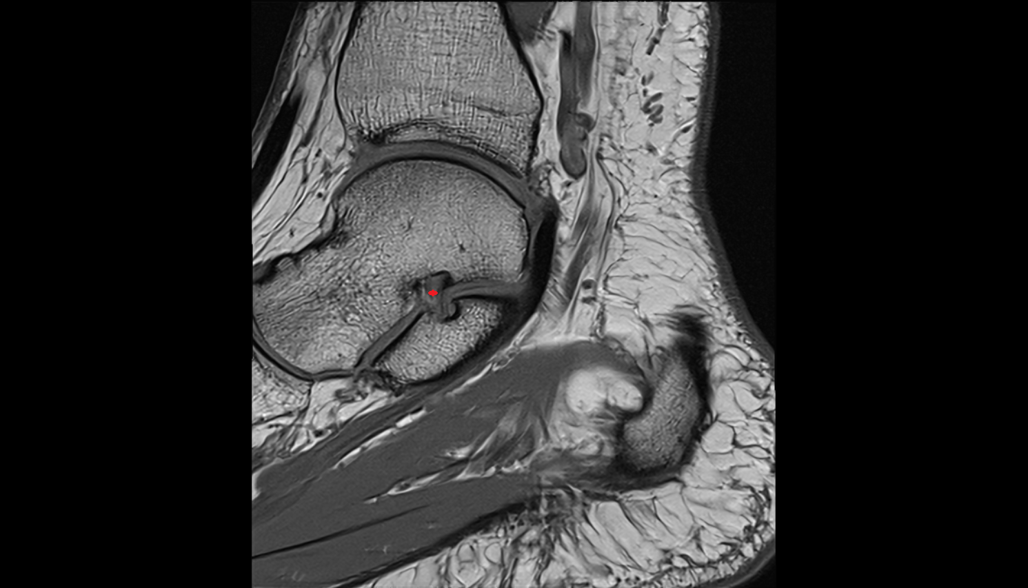 Talocalcaneal interosseous ligament coronal cross sectional anatomy 3T MRI AI enhanced radiology image-img-00000-00000_00001
