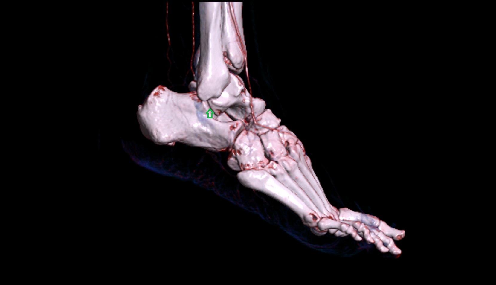 Talocalcaneal joint (subtalar joint) 3d