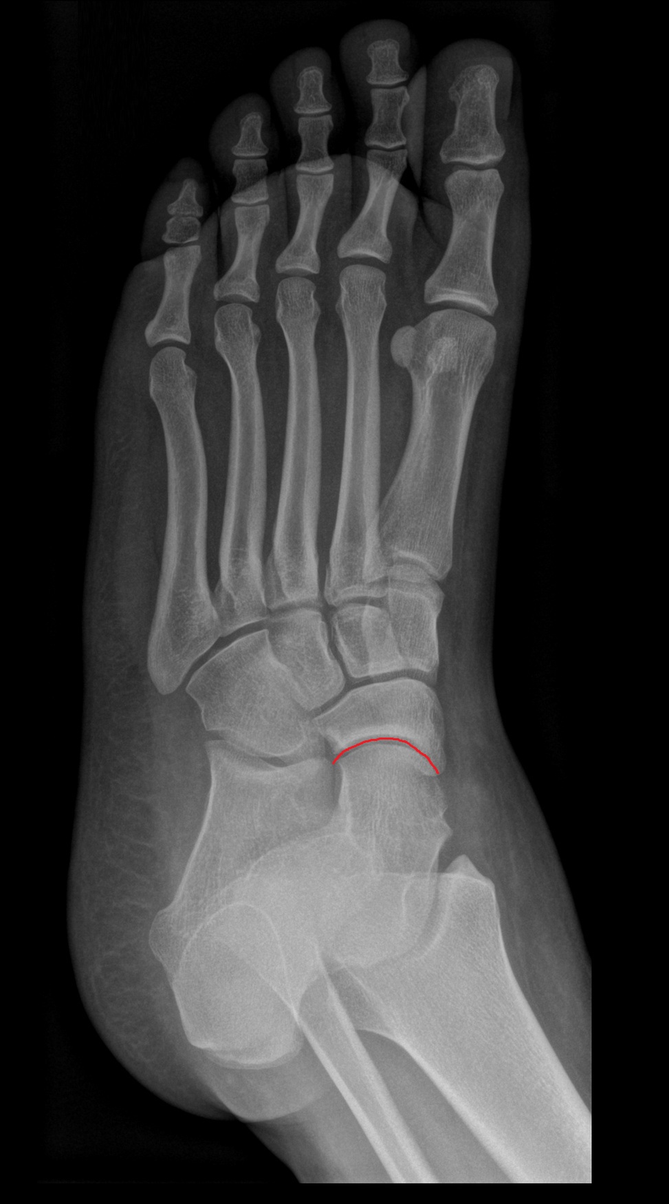 Talocalcaneonavicular joint