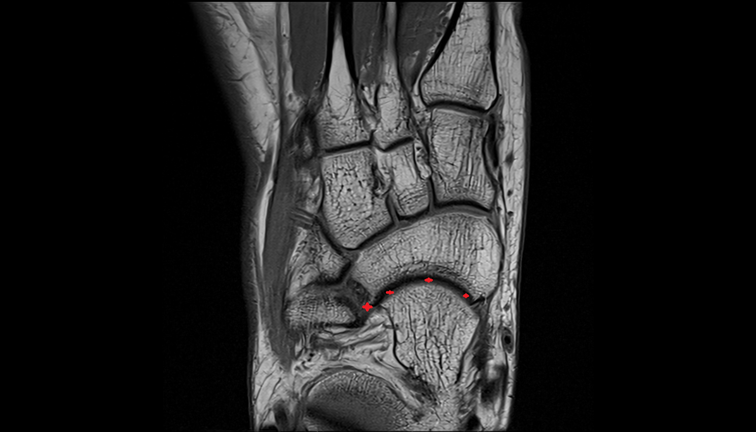 Talocalcaneonavicular joint  MRI axial  cross sectional anatomy 3T MRI AI enhanced radiology image-img-00000-00000