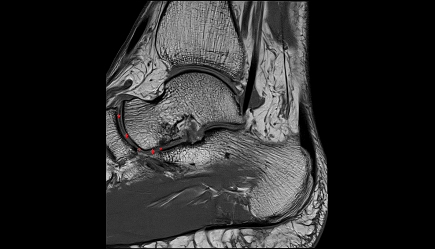 Talocalcaneonavicular joint  MRI sagittal  cross sectional anatomy 3T MRI AI enhanced radiology image-img-00000-00000