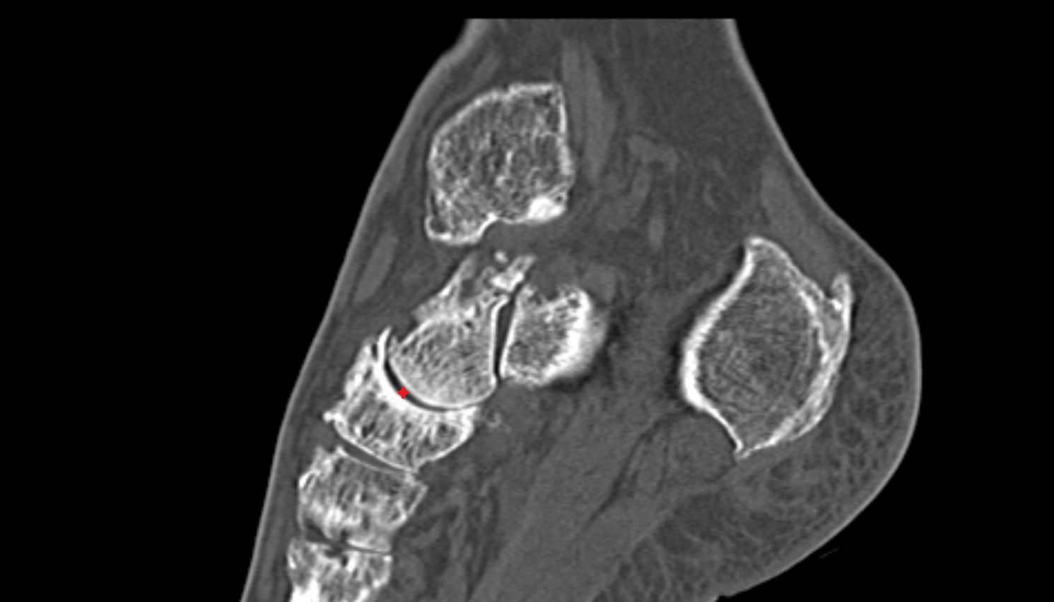 Talocalcaneonavicular joint sagittal  CT cross sectional anatomy radiology image-img-00000-00000