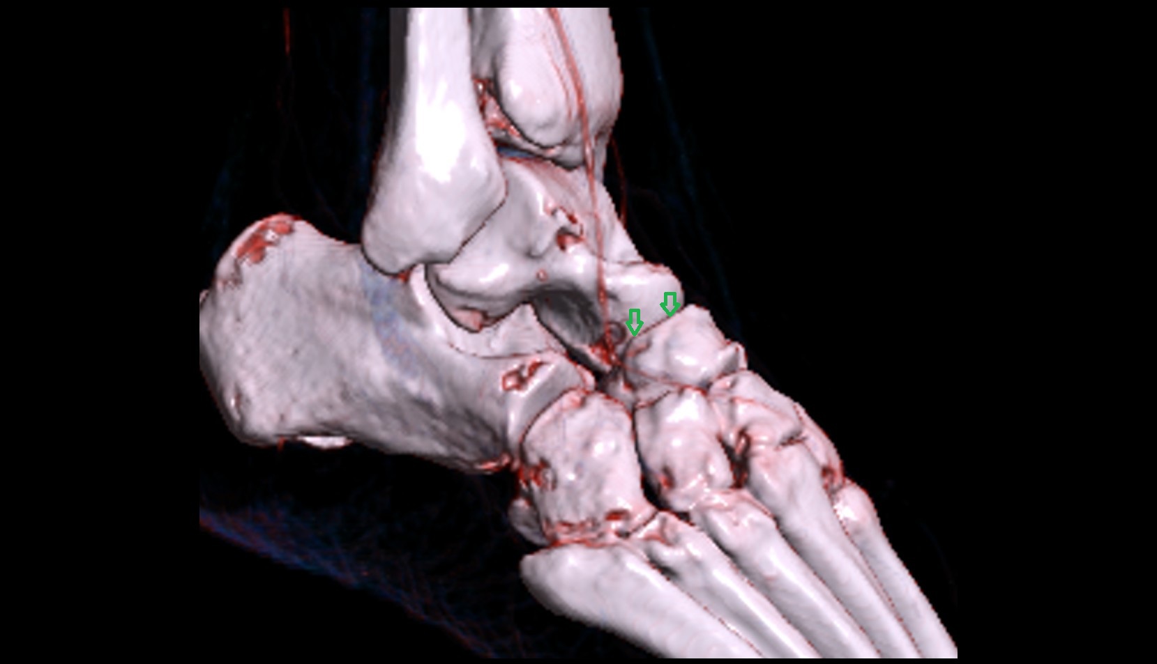 Talonavicular joint