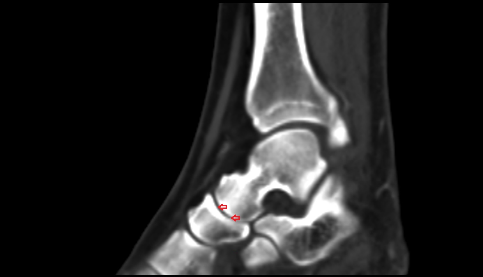 Talonavicular joint ct
