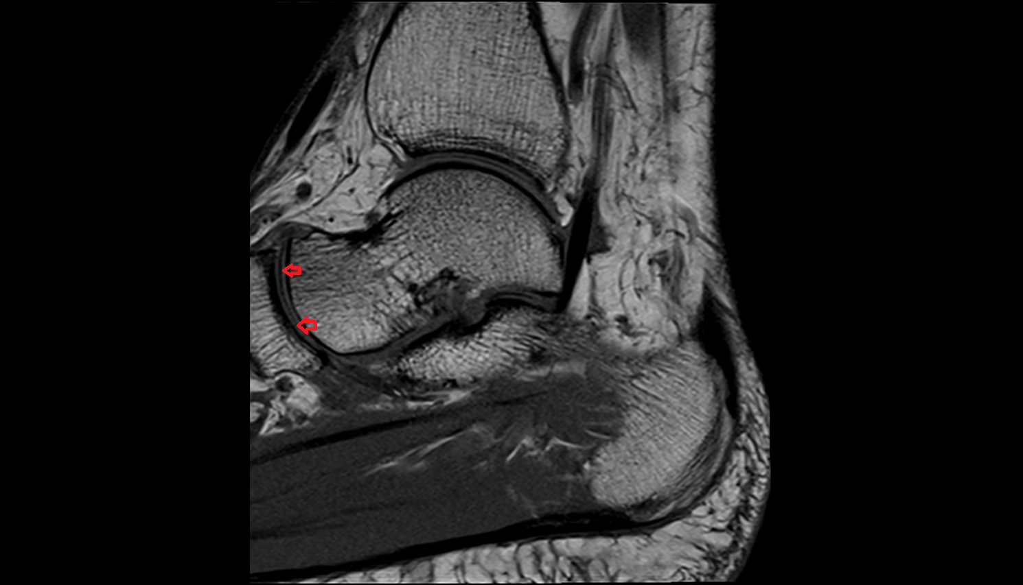 Talonavicular joint  mri  anatomy labelled image-img-00000-00000