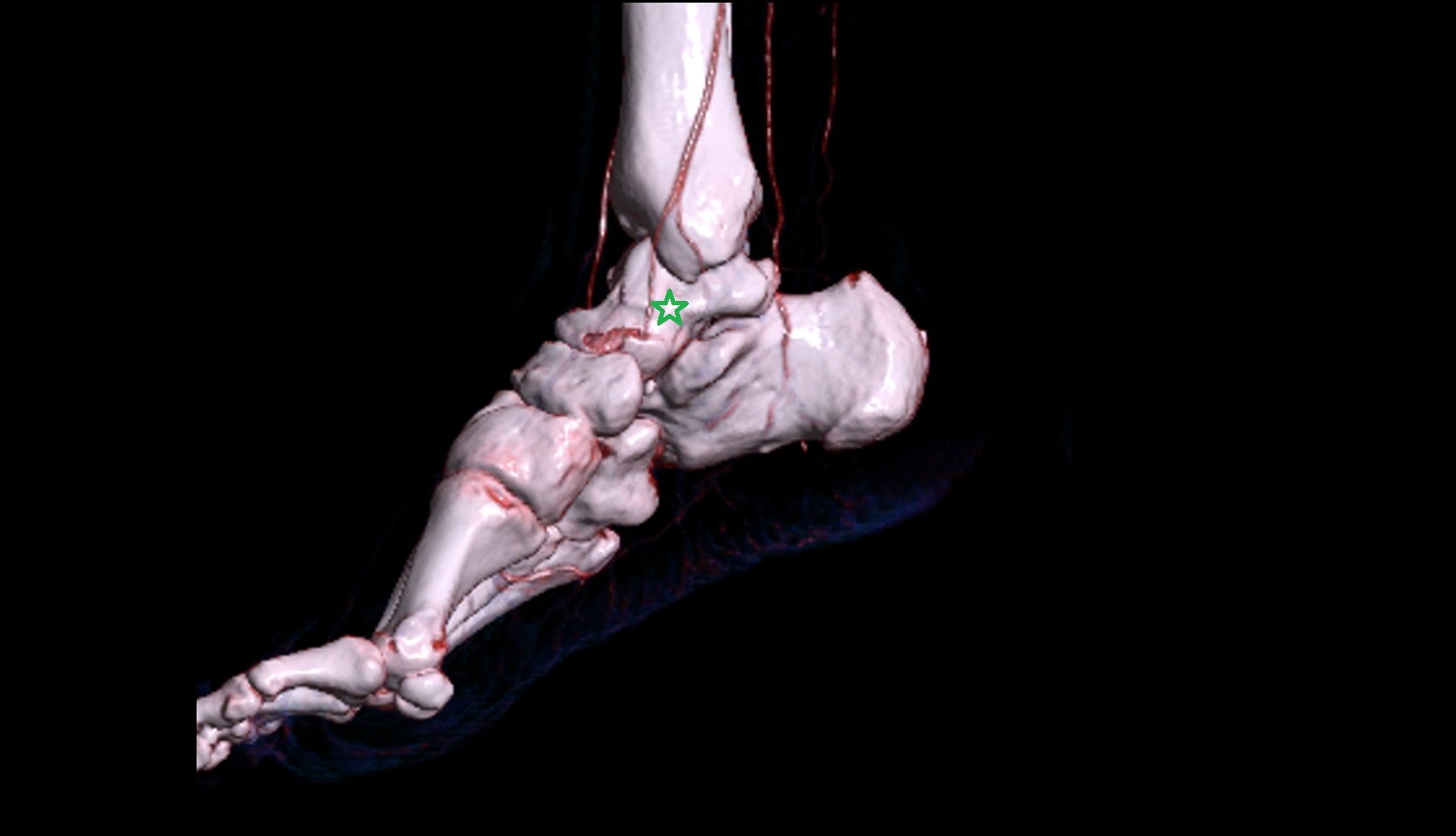 Talus bone 3d image ct