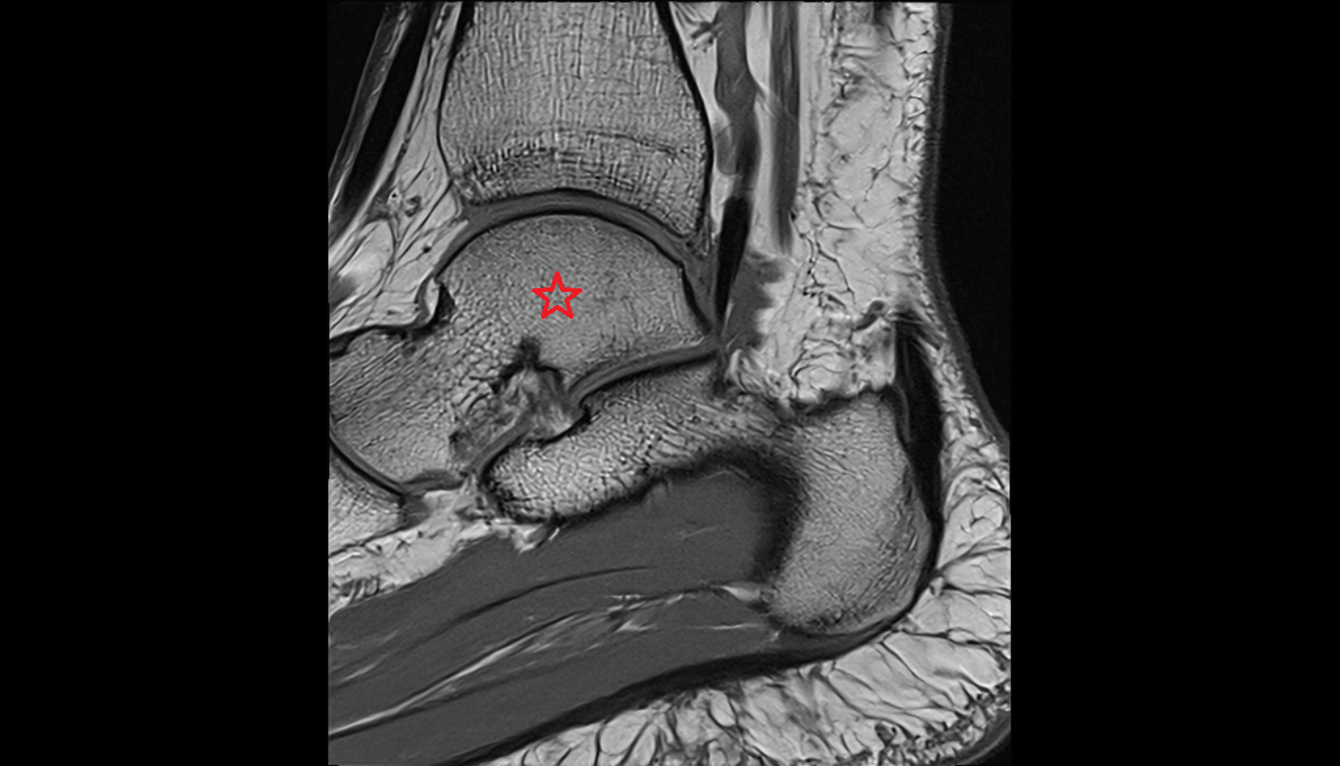 Talus sag MRI cross sectional anatomy 3T MRI AI enhanced radiology image-img-00000-00000
