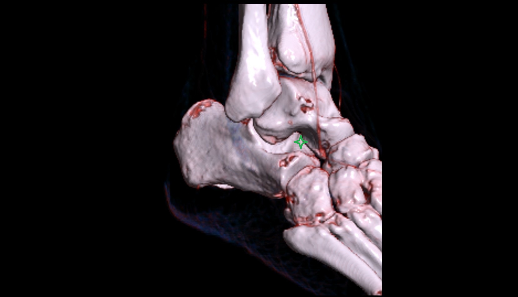 Tarsal sinus 3D
