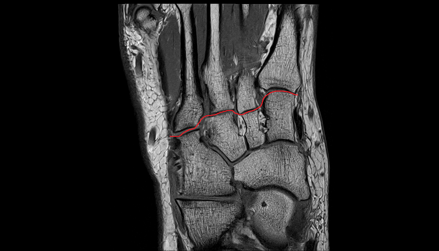 Tarsometatarsal joints coronal cross sectional anatomy 3T MRI AI enhanced radiology image-img-00000-00000