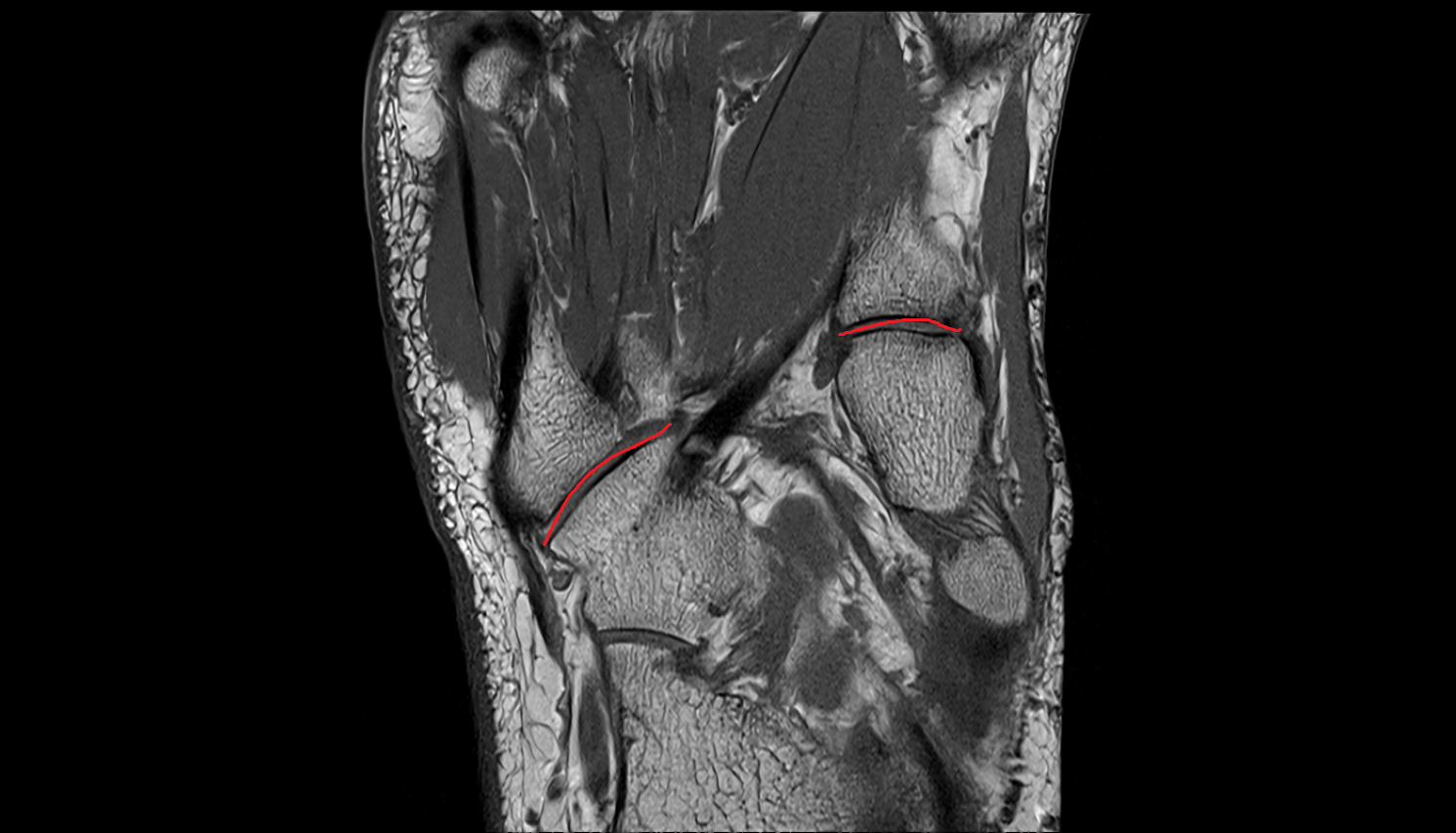 Tarsometatarsal joints coronal cross sectional anatomy 3T MRI AI enhanced radiology image-img-00000-00000_00001