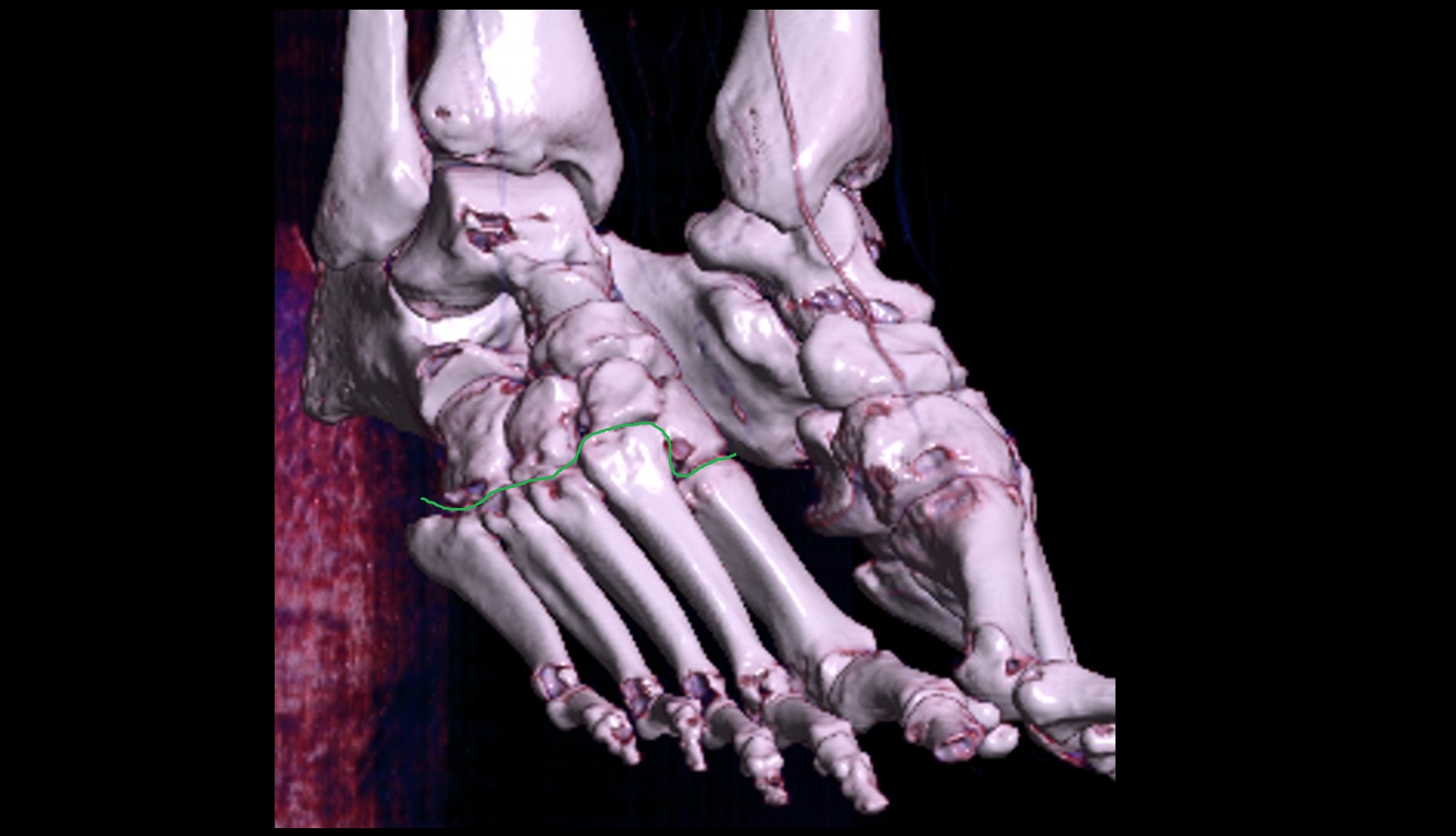 Tarsometatarsal joints ct 3d image