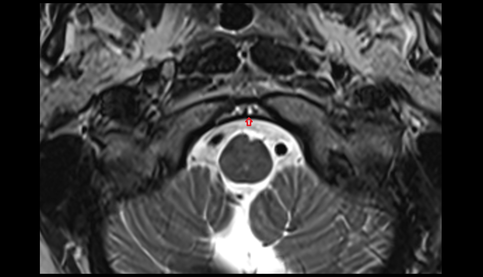 Tectorial Membrane mri axial image