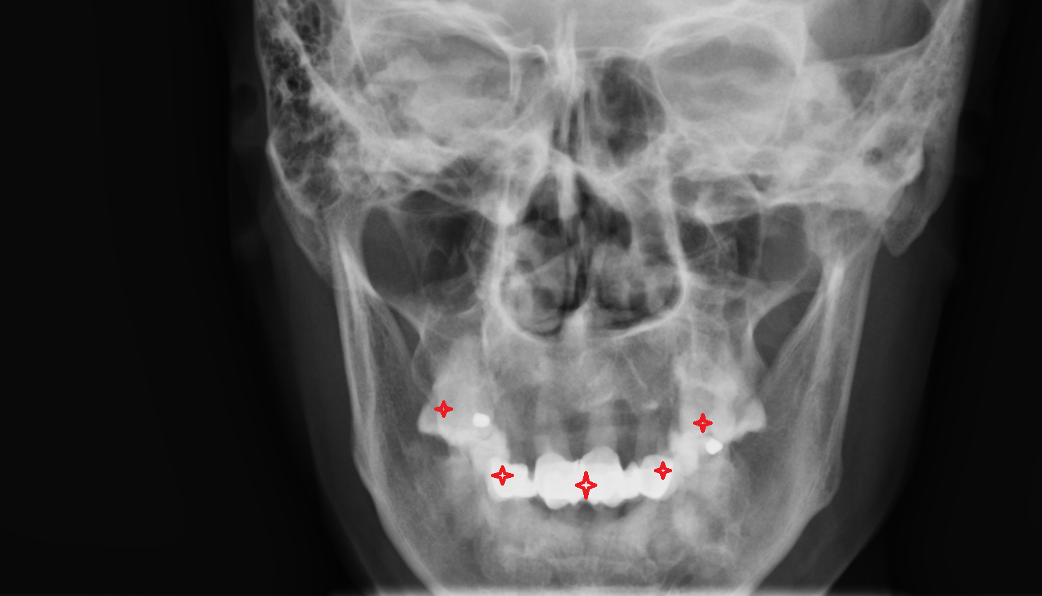 Teeth X RAY  anatomy image -img-00000-00000