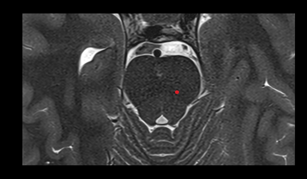Tegmentum of midbrain mri 3t axial image