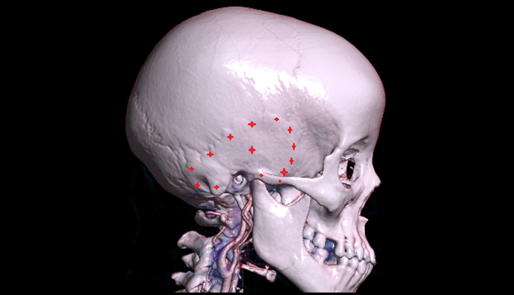 Temporal bone 3d