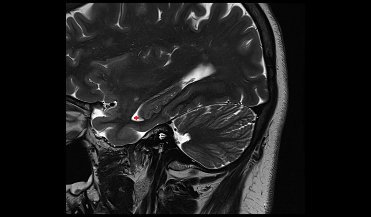 Temporal horn of lateral ventricle; Inferior horn of lateral ventricle mri 3t sagottal image