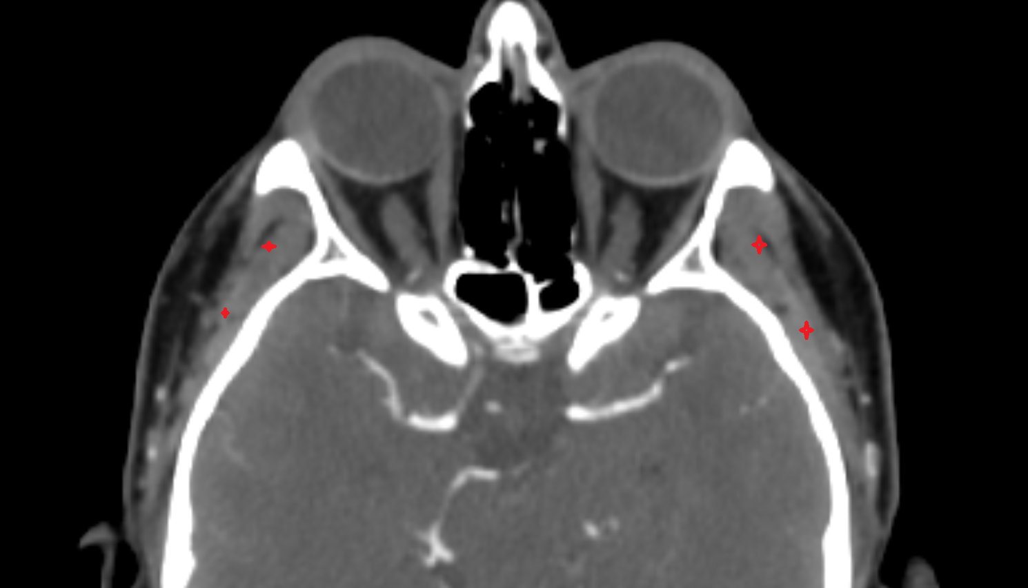 Temporalis muscle CT axial  image-img-00000-00000