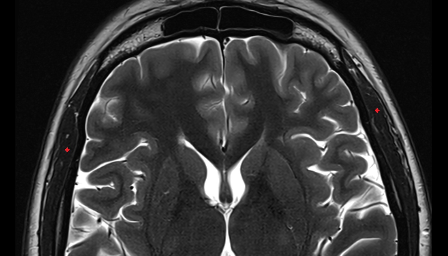 Temporalis muscle mri axial image -img-00000-00000