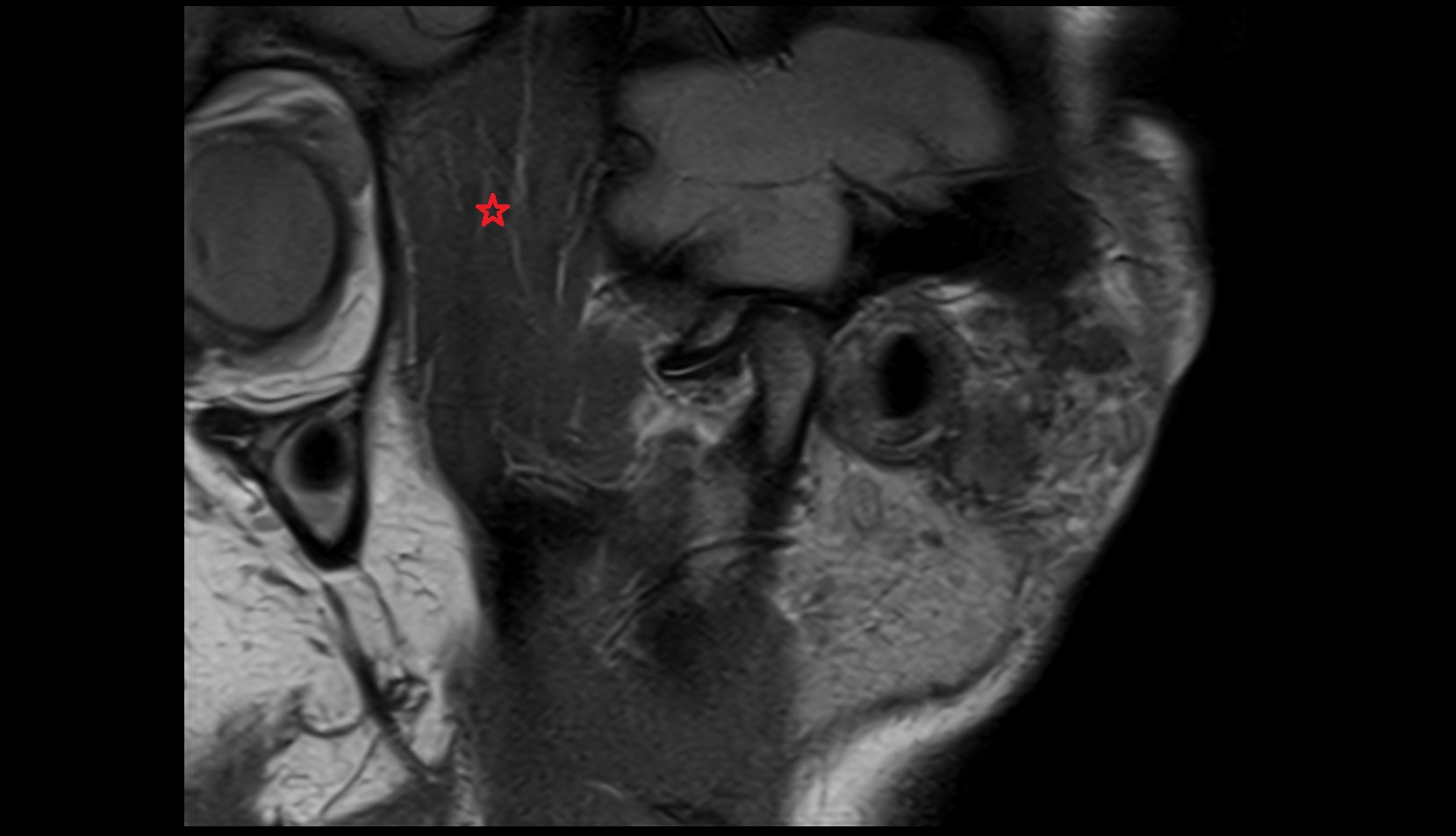 Temporalis muscle mri image