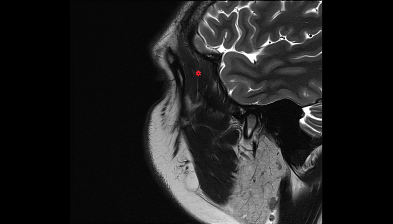 Temporalis muscle mri sagittal image -img-00000-00000