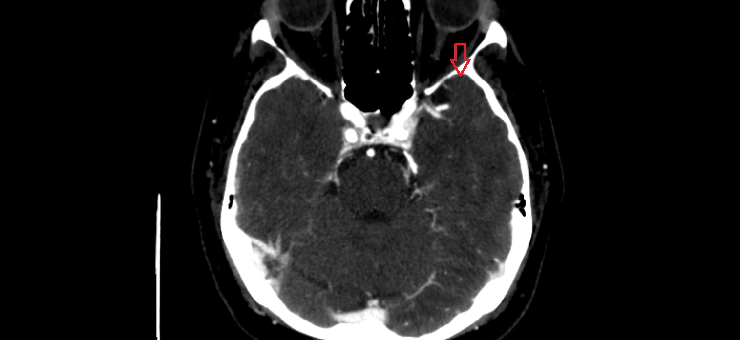 Temporal pole CT axial  cross sectional anatomy radiology image -img-00001-00001