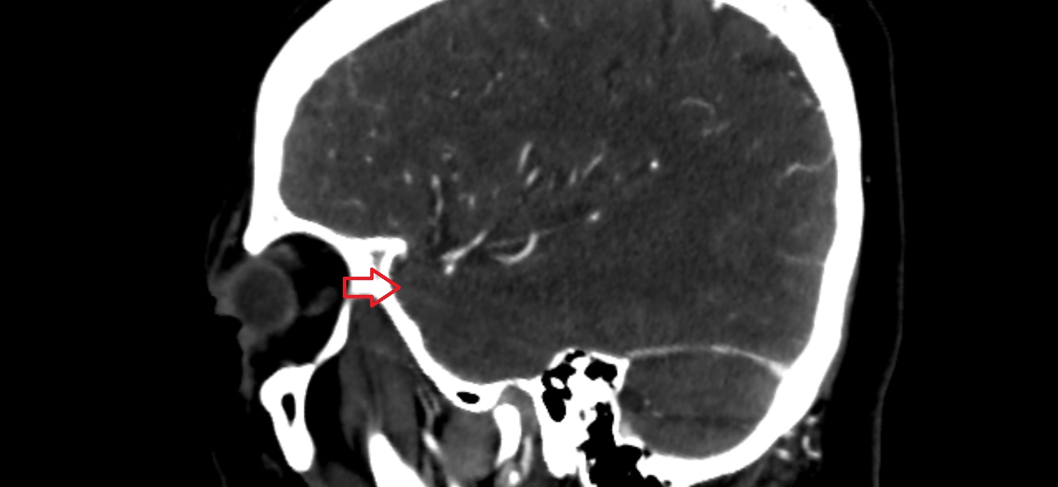 Temporal pole CT sagittal  cross sectional anatomy radiology image -img-00001-00001