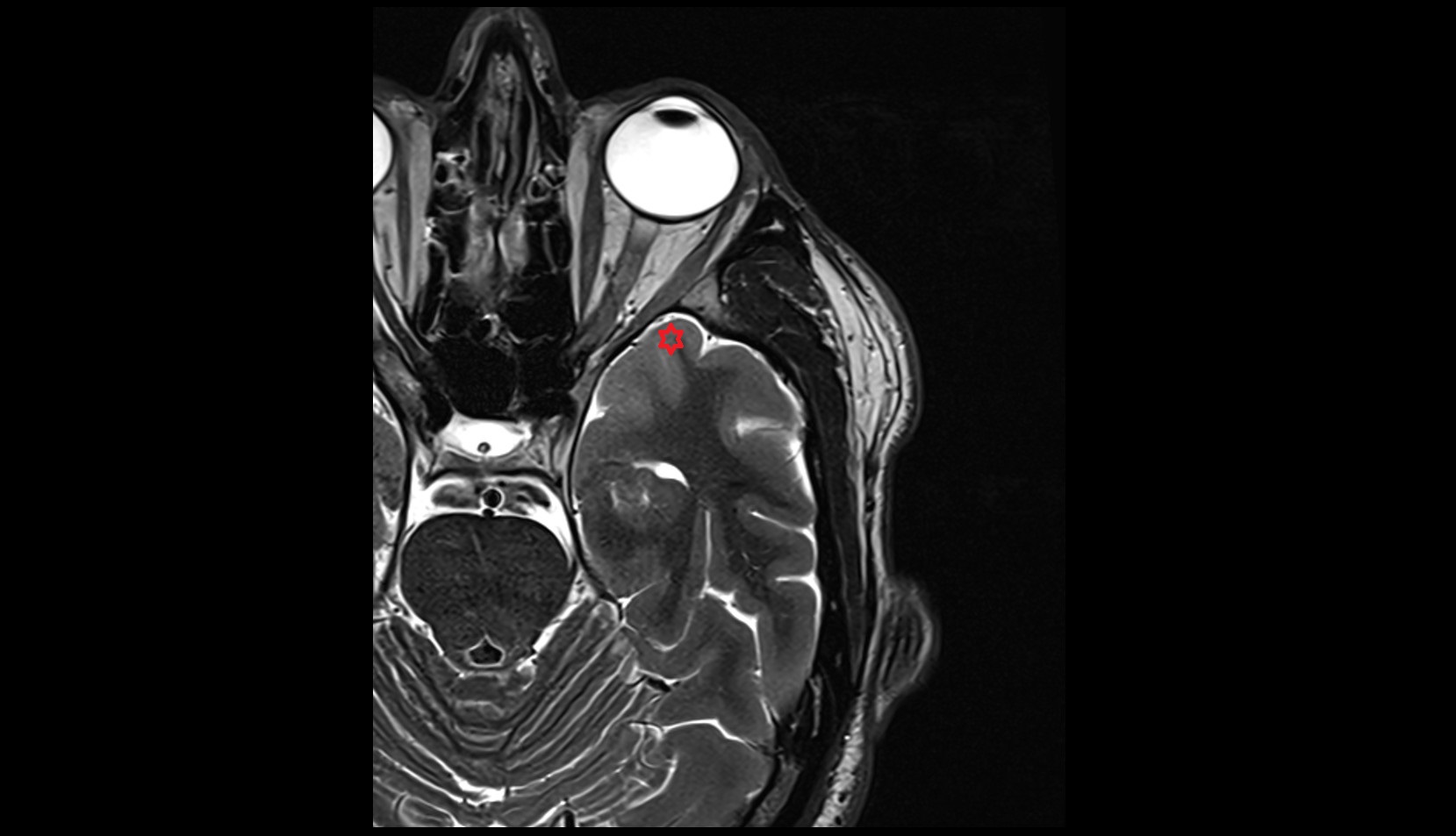 Temporal pole mri 3t axial image