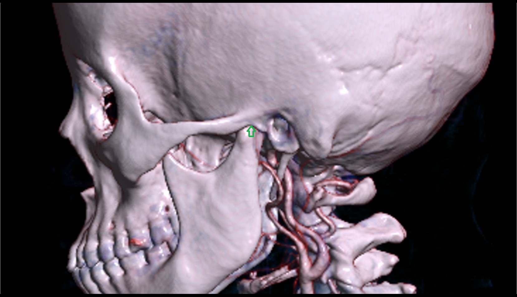 Temporomandibular joint 3D