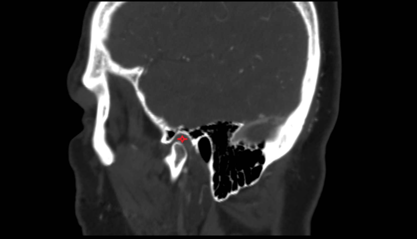 Temporomandibular joint CT