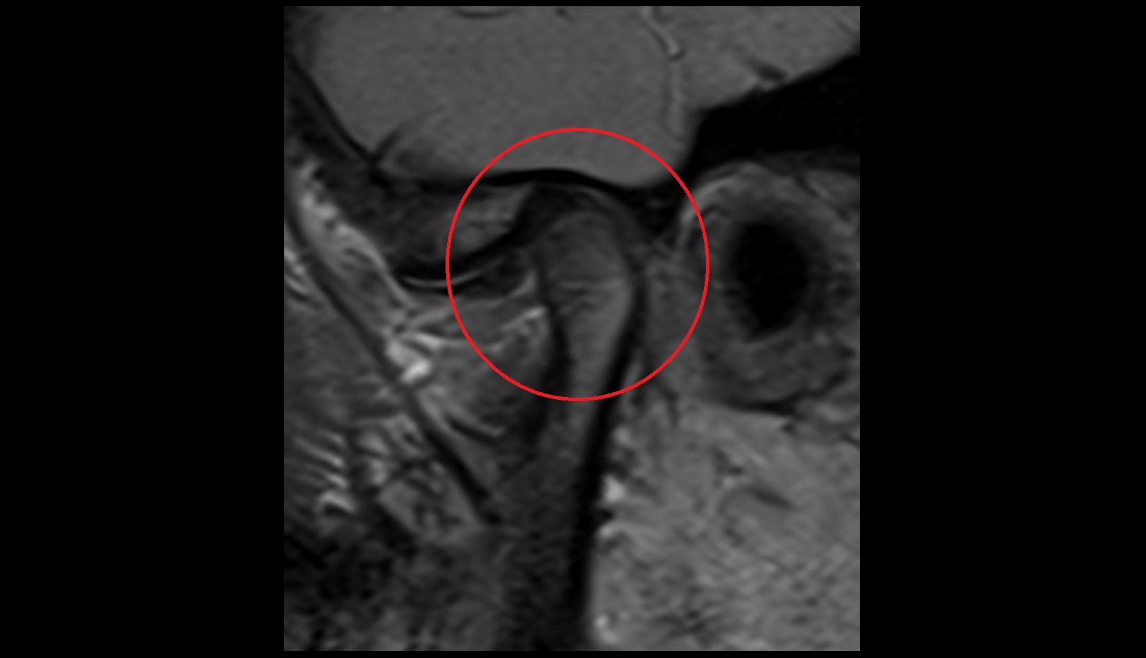 Temporomandibular joint mri iamge