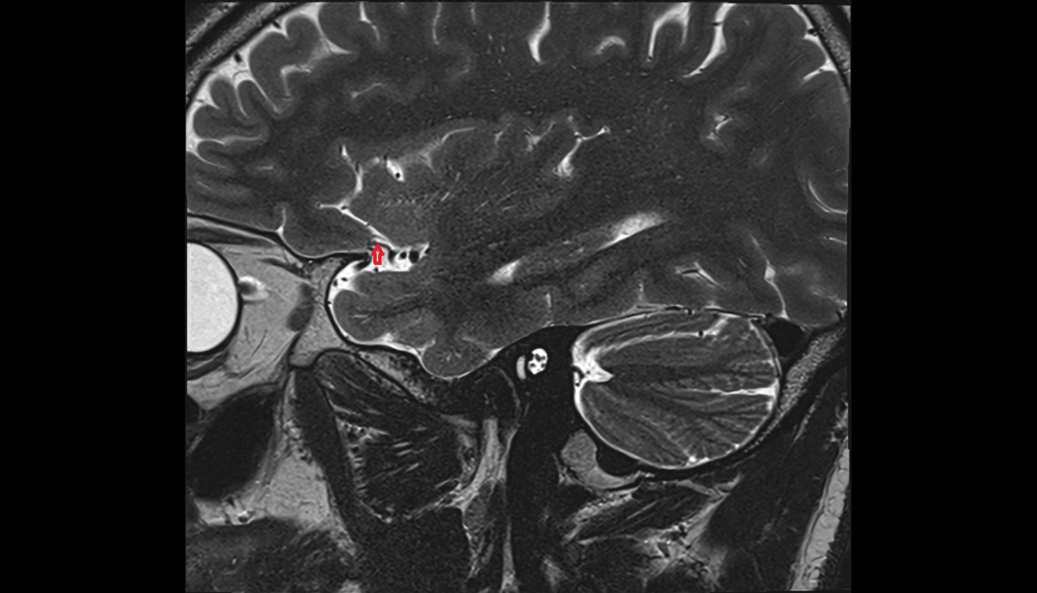 Temporopolar artery mri sagittal  image -img-00000-00000