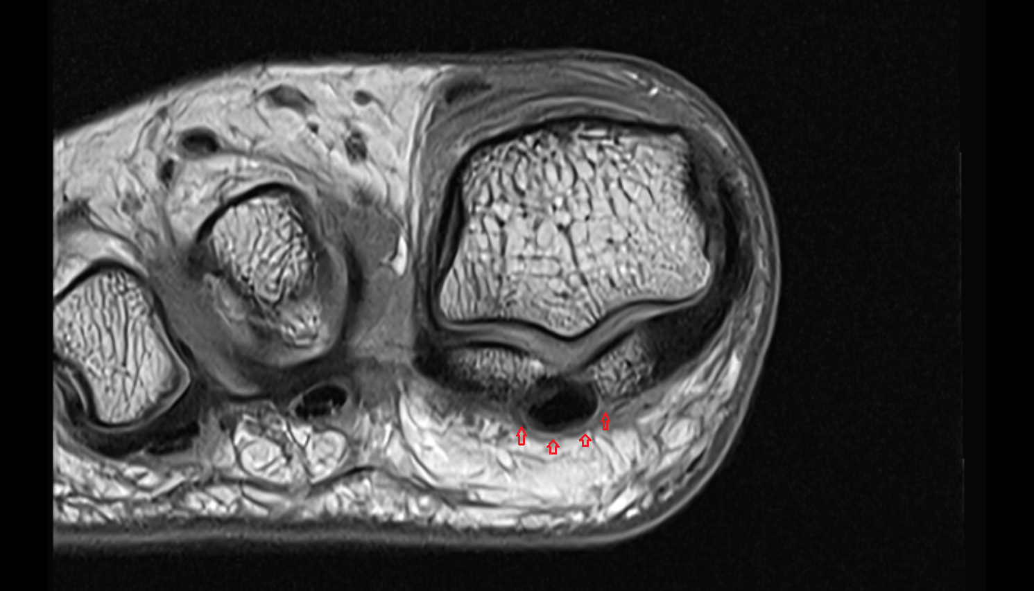 Tendon sheath AXIAL cross sectional anatomy 3T MRI AI enhanced radiology image-img-00000-00000