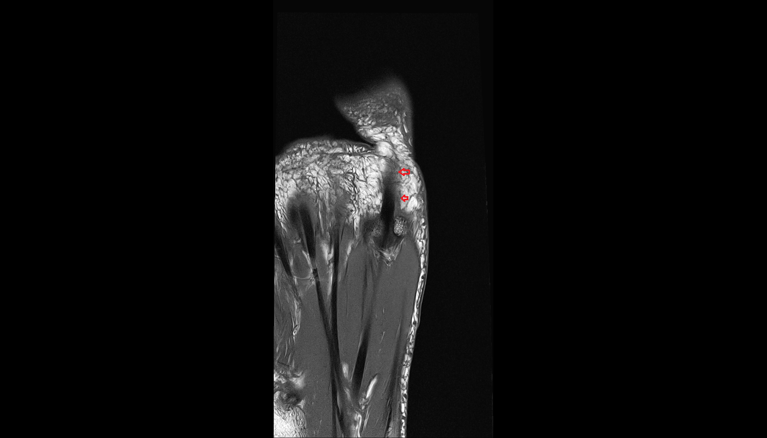 Tendon sheath coronal cross sectional anatomy 3T MRI AI enhanced radiology image-img-00000-00000