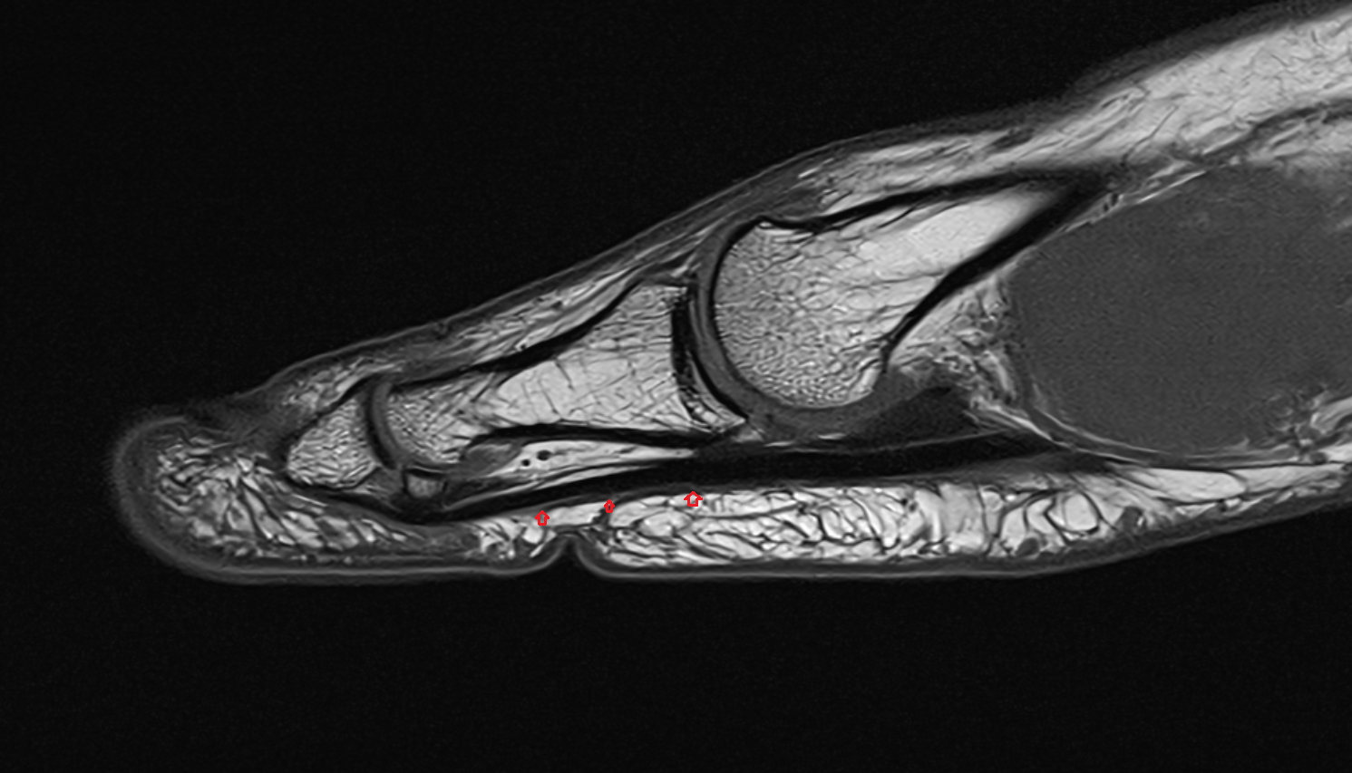 Tendon sheath sag cross sectional anatomy 3T MRI AI enhanced radiology image-img-00000-00000