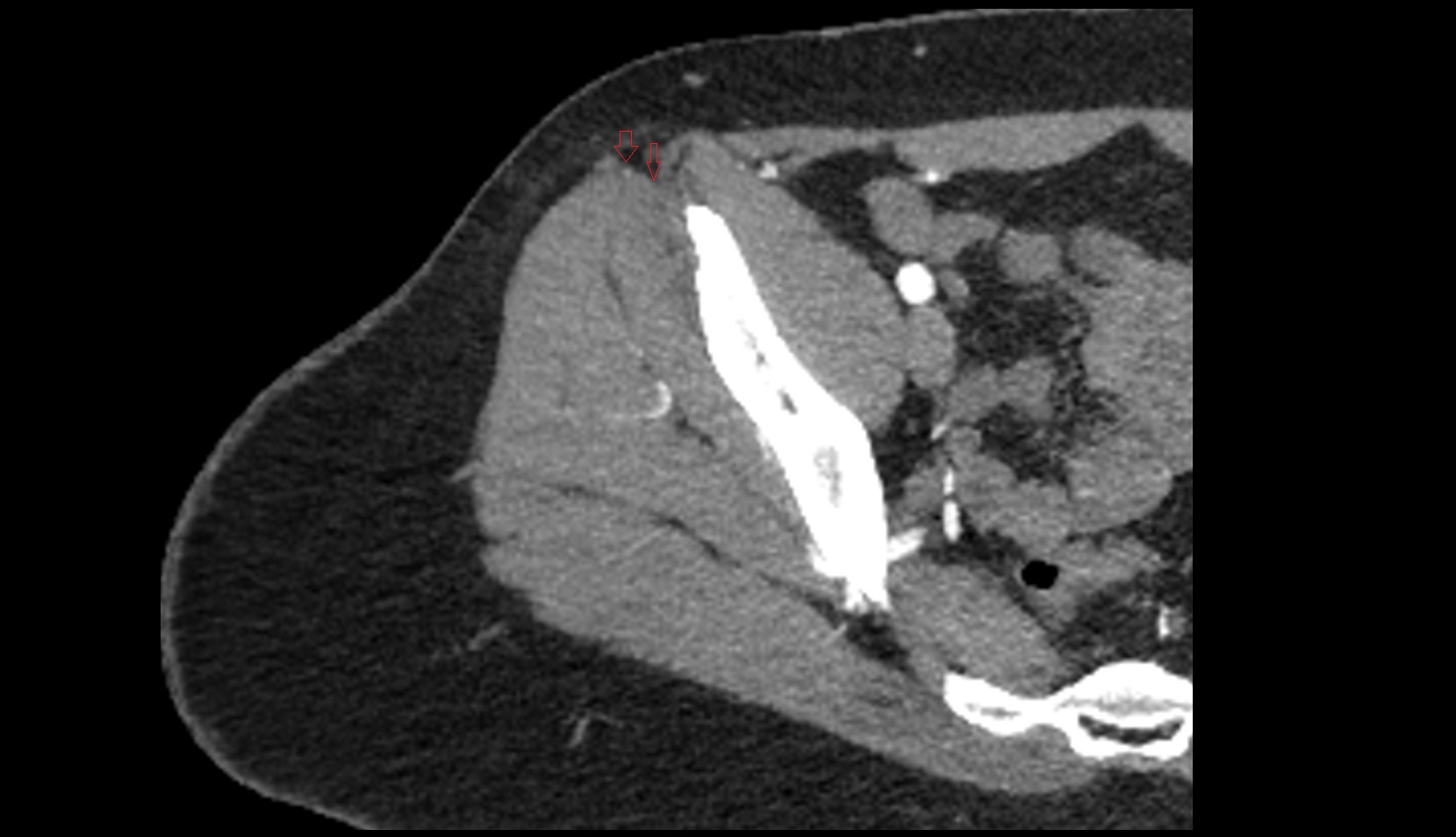 Tensor Fasciae Latae Tendon ct axial