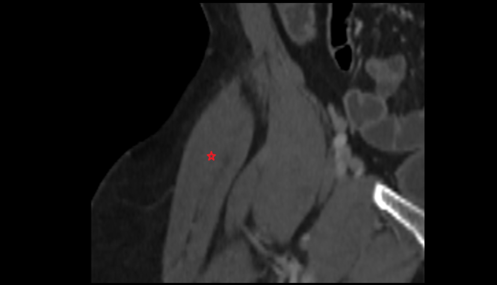 Tensor fasciae latae muscle CORONAL