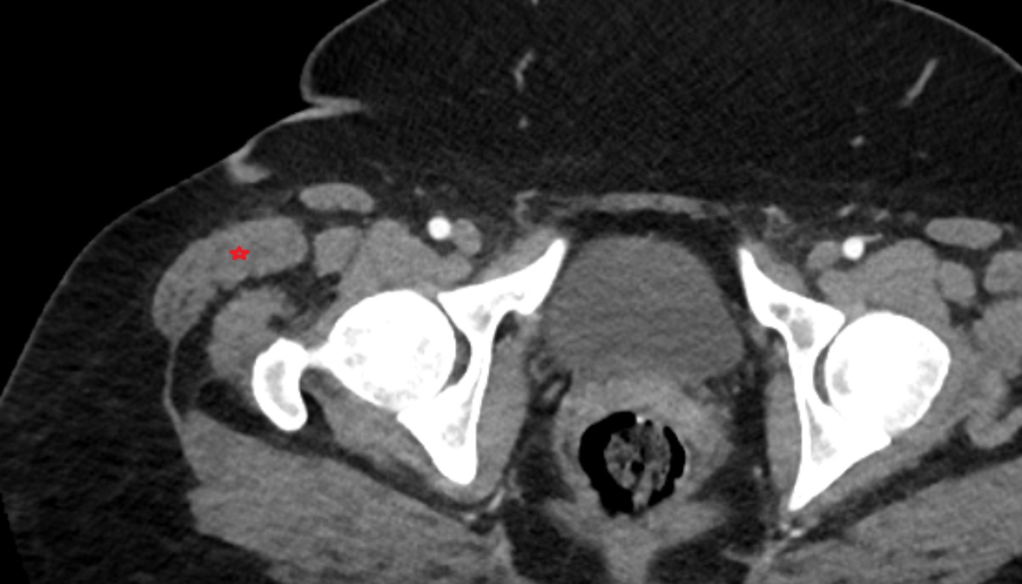 Tensor fasciae latae muscle CT axial  anatomy  image-img-00000-00000_00001