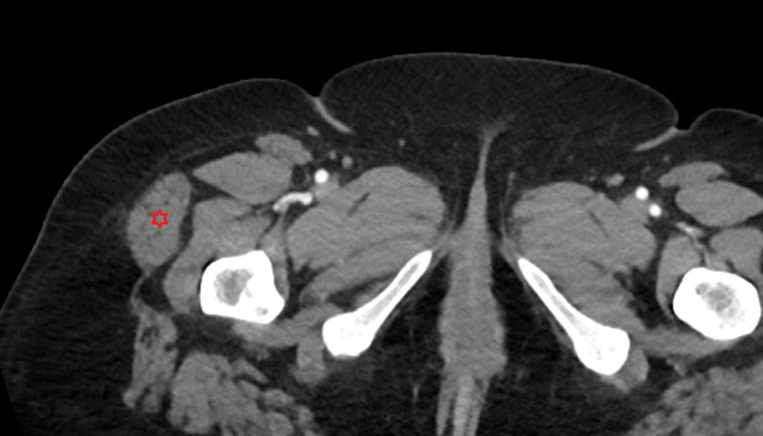 Tensor fasciae latae muscle CT axial  anatomy  image-img-00000-00000_00002