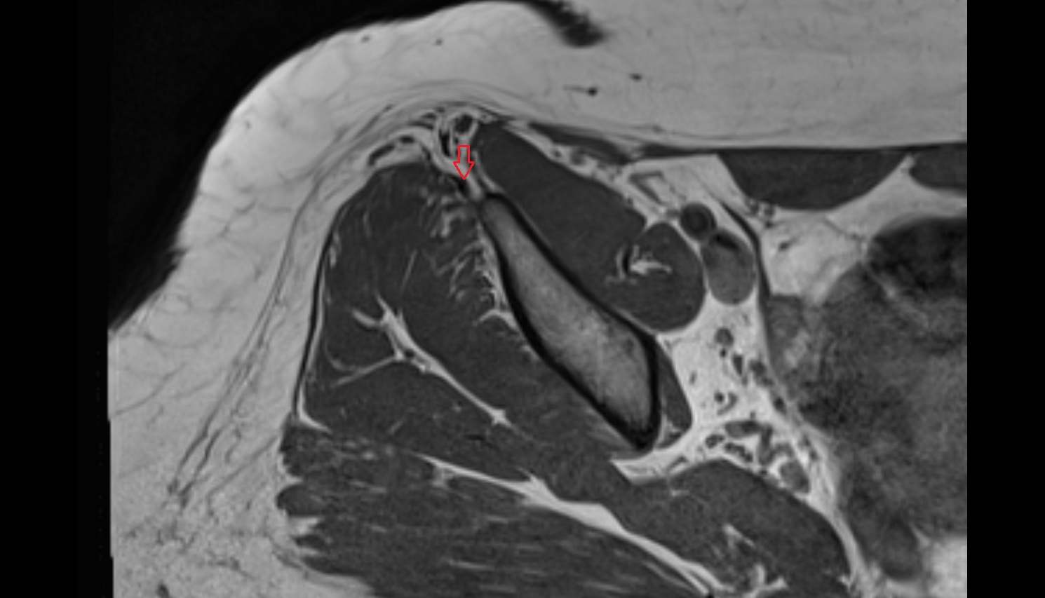 Tensor fasciae latae tendon  MRI axial anatomy image-img-00000-00000